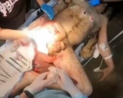Russian soldier undergoes field surgery