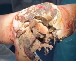 Russian soldier’s necrotic foot after stepping on landmine