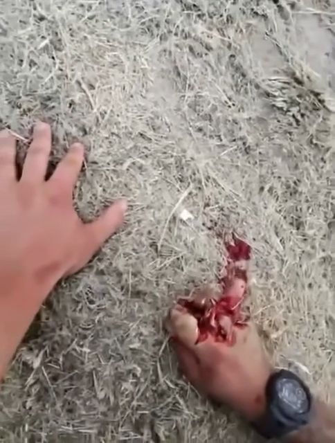 Soldier suffered serious hand injury while operating mortar • GoreCenter