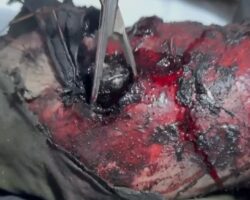Surgeon removes FPV drone battery lodged in Russian soldier’s leg