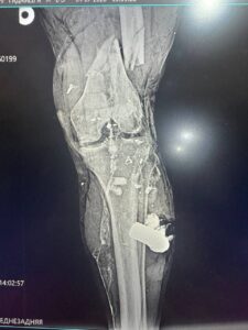Surgeon removes FPV drone battery lodged in Russian soldier's leg