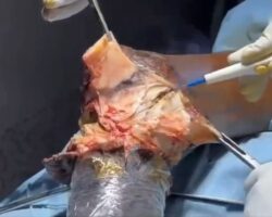 Amputation of gangrenous leg