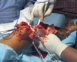 Amputation of necrotic arm