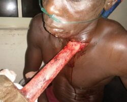 Bricklayer impaled by hammer in freak accident