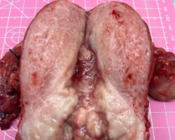 Complete hysterectomy + bilateral oophorectomy