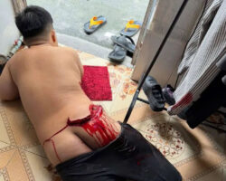 Deep cut caused by improper toilet use