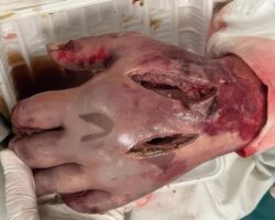 Fish bite turns into deadly infection