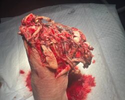 Landmine explosion destroyed Ukrainian soldier’s foot