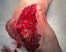 Landmine tore Russian soldier’s foot