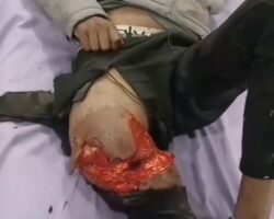 Leg destroyed in traffic accident