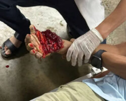 Man lost his hand in workplace accident