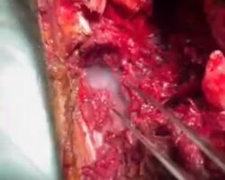 Medics remove burning white phosphorus