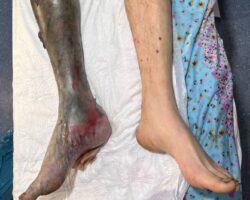 Necrotic leg of Russian soldier