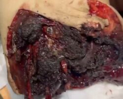 Russian soldier suffered traumatic limb amputation