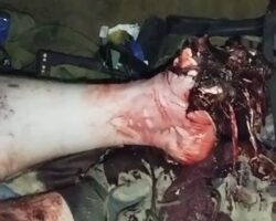 Treatment of critically wounded Ukrainian soldier