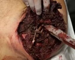 Ukrainian soldier suffered shoulder injury