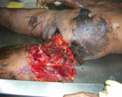 Fisherman dies after fishing net tears off his leg