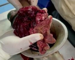 Hand completely destroyed by meat grinder