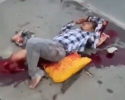 Traumatic leg amputation in rickshaw accident
