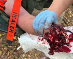 Treatment of Russian soldier’s traumatic amputation of right hand