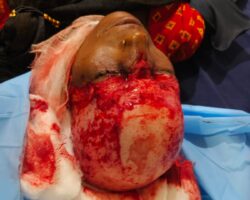 Young woman scalped by ferris wheel