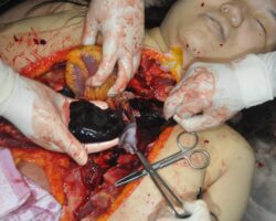 Autopsy of stabbed Chinese woman #5