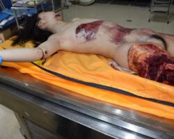 Fall from building killed her and tore off her leg