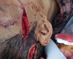 Mass brawl leaves several injured