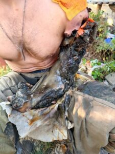 Necrotic arm of Russian soldier