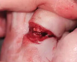 Woman amputated her middle toe