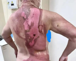Woman scalded with hot water by her abusive boyfriend