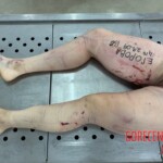 Female corpse in morgue