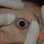 Naked dead woman in morgue