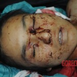 Murdered woman on autopsy table