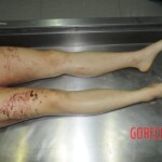 Murdered woman on autopsy table