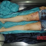 Murdered woman on autopsy table