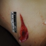 Murdered woman on autopsy table