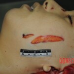 Murdered woman on autopsy table