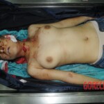 Murdered woman on autopsy table