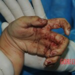 Murdered woman on autopsy table