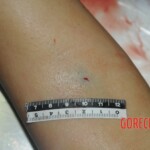 Murdered woman on autopsy table