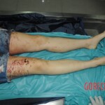 Murdered woman on autopsy table