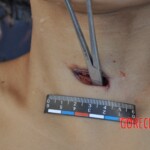 Murdered young woman with knife in pussy + autopsy