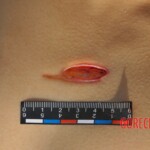 Murdered young woman with knife in pussy + autopsy