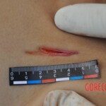 Murdered young woman with knife in pussy + autopsy