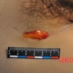 Murdered young woman with knife in pussy + autopsy