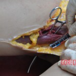 Murdered young woman with knife in pussy + autopsy