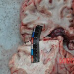 Murdered young woman with knife in pussy + autopsy