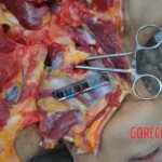 Murdered young woman with knife in pussy + autopsy