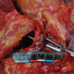 Murdered young woman with knife in pussy + autopsy